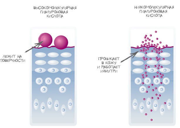 Hyaluronic acid for lips: before and after photos, pros and cons, effect, contraindications. Procedure price and reviews