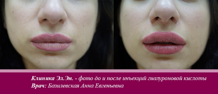 Hyaluronic acid for lips: before and after photos, pros and cons, effect, contraindications. Procedure price and reviews