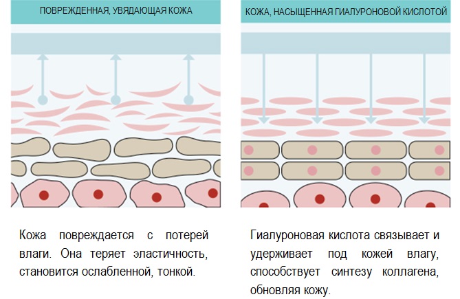 Hyaluronic acid for lips: before and after photos, pros and cons, effect, contraindications. Procedure price and reviews