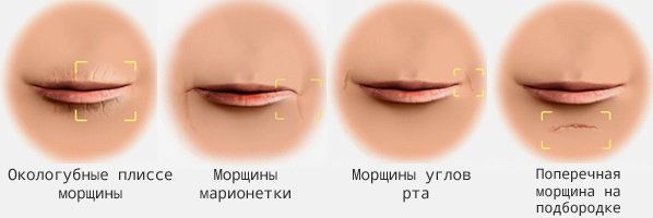 Hyaluronic acid for lips: before and after photos, pros and cons, effect, contraindications. Procedure price and reviews