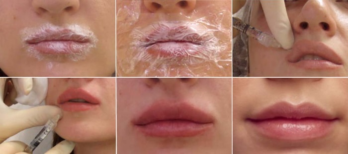 Hyaluronic acid for lips: before and after photos, pros and cons, effect, contraindications. Procedure price and reviews