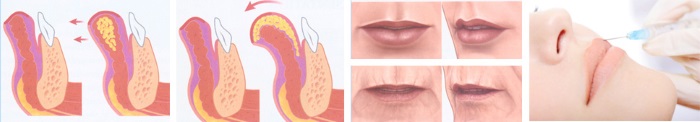 Hyaluronic acid for lips: before and after photos, pros and cons, effect, contraindications. Procedure price and reviews