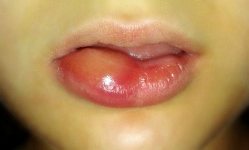 Hyaluronic acid for lips: before and after photos, pros and cons, effect, contraindications. Procedure price and reviews