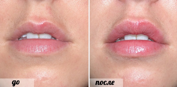 Lips before and after hyaluronic acid photo before and after augmentation. How long does the effect last when edema disappears