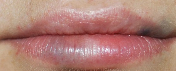 Lips before and after hyaluronic acid photo before and after augmentation. How long does the effect last when edema disappears