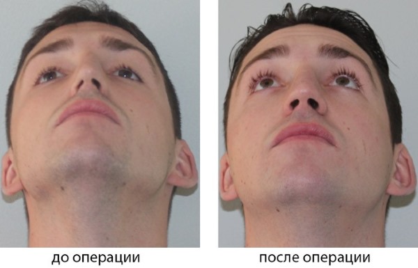 Curvature of the nasal septum. Symptoms, causes and consequences. Septoplasty operation: indications, contraindications, types and features