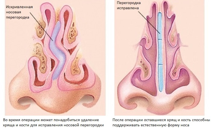 Curvature of the nasal septum. Symptoms, causes and consequences. Septoplasty operation: indications, contraindications, types and features