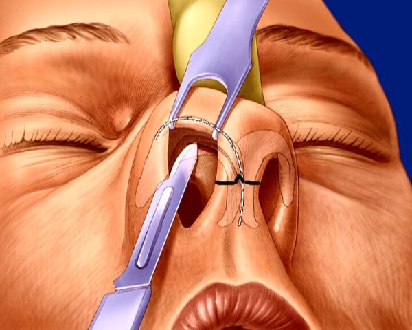 Curvature of the nasal septum. Symptoms, causes and consequences. Septoplasty operation: indications, contraindications, types and features