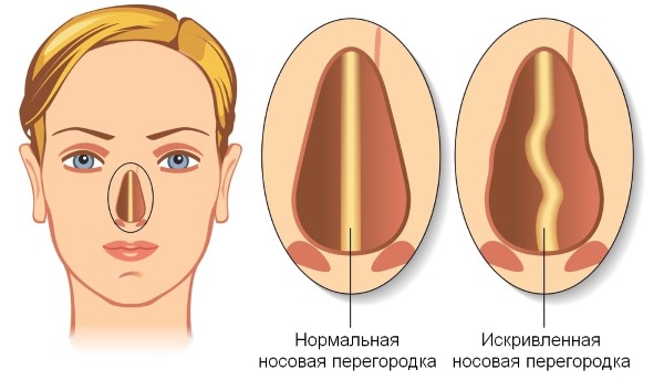 Curvature of the nasal septum. Symptoms, causes and consequences. Septoplasty operation: indications, contraindications, types and features