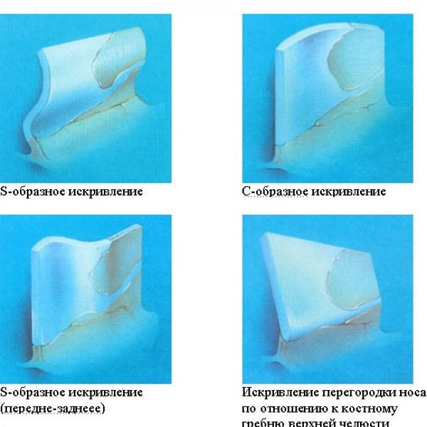 Curvatura del setto nasale. Sintomi, cause e conseguenze. Intervento di settoplastica: indicazioni, controindicazioni, tipologie e caratteristiche