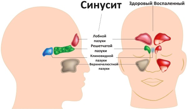 Curvature of the nasal septum. Symptoms, causes and consequences. Septoplasty operation: indications, contraindications, types and features