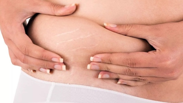 How to get rid of stretch marks, remove on the chest, stomach, buttocks, body, legs, hips after childbirth, during pregnancy. Creams, oil, mummy, laser removal