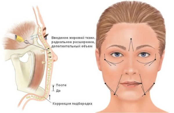 How to remove nasolabial folds: fillers, hyaluronic acid, contour correction, botox and lipofilling, facial exercises