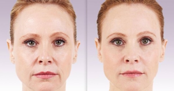 How to remove nasolabial folds: fillers, hyaluronic acid, contour correction, botox and lipofilling, facial exercises