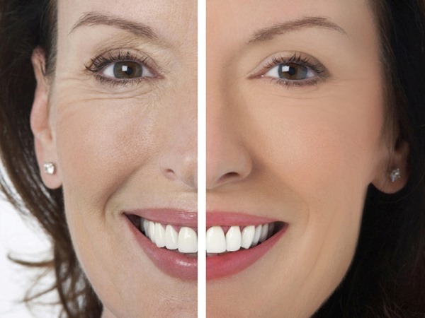 How to remove nasolabial folds: fillers, hyaluronic acid, contour correction, botox and lipofilling, facial exercises