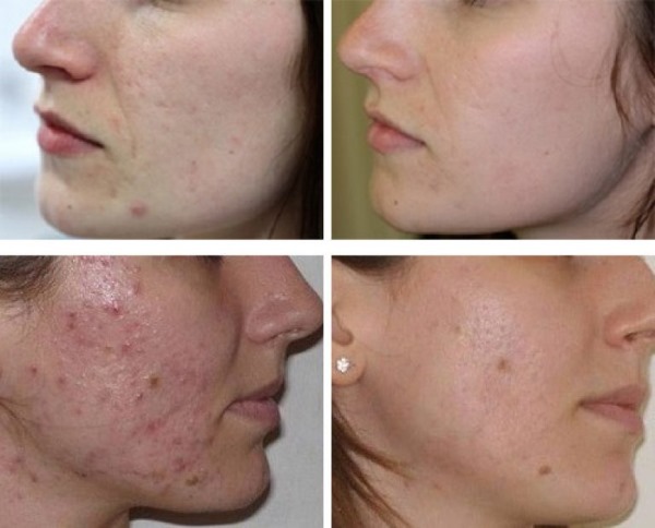 How to use Levomekol for acne on the face. Instructions, indications and contraindications