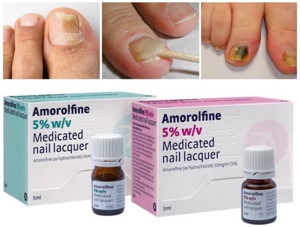 Loceryl varnish for nail fungus. Instructions on how to use, analogues, price, reviews