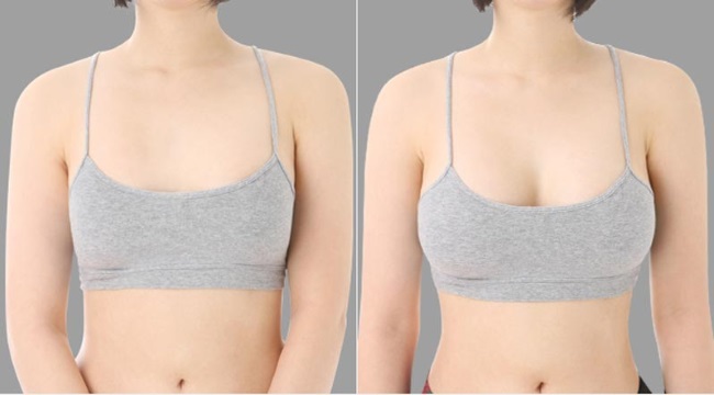 Small breasts. Mammoplasty for breast augmentation: how it goes, how much does it cost, rehabilitation, indications and contraindications