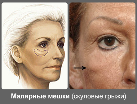 How to get rid of paint bags on the cheekbones without surgery, folk remedies, lipolysis in cosmetology