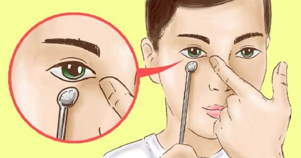 How to get rid of paint bags on the cheekbones without surgery, folk remedies, lipolysis in cosmetology