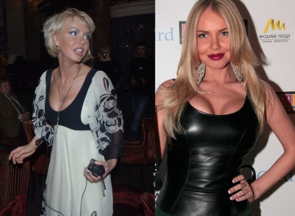 Masha Malinovskaya before and after plastic surgery. Photo, age, height and weight