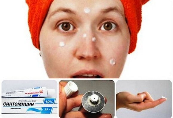 Ointments for acne on the face: inexpensive and effective with an antibiotic, for red, blackheads, acne, marks, for teens. Names and prices