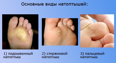 Corns on the feet - treatment, quick disposal at home. A photo