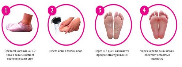 Calluses on the feet - treatment, quick disposal at home. A photo