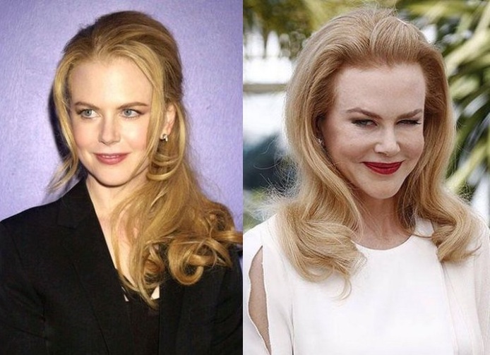 Top 10 unsuccessful plastic surgery stars. Photos before and after Soviet, Russian, foreign, Hollywood actors