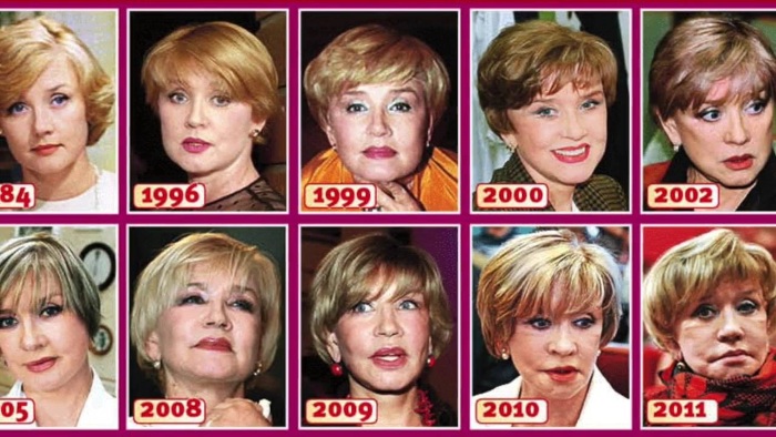 Top 10 unsuccessful plastic surgery stars. Photos before and after Soviet, Russian, foreign, Hollywood actors