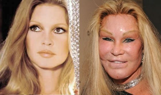 Top 10 unsuccessful plastic surgery stars. Photos before and after Soviet, Russian, foreign, Hollywood actors