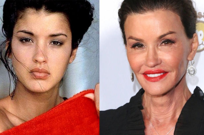 Top 10 unsuccessful plastic surgery stars. Photos before and after Soviet, Russian, foreign, Hollywood actors