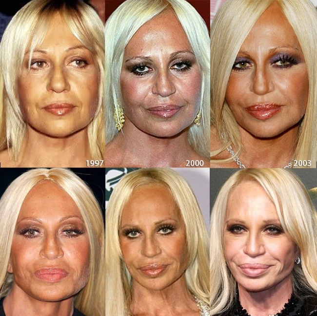 Top 10 unsuccessful plastic surgery stars. Photos before and after Soviet, Russian, foreign, Hollywood actors