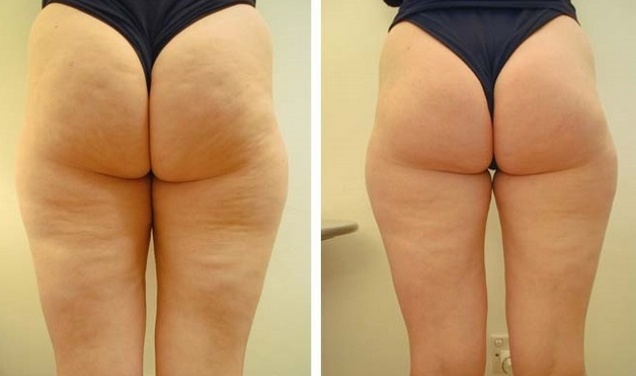 Impacco cellulite con crema Capsicam su cosce, glutei, addome. Ricette fatte in casa efficaci