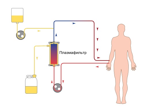 Plasmaphoresis - indications for use in gynecology, pregnancy, allergies, psoriasis. Possible side effects, cost of the procedure