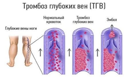 Plasmaphoresis - indications for use in gynecology, pregnancy, allergies, psoriasis. Possible side effects, cost of the procedure