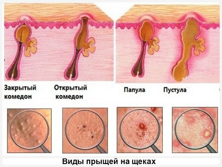 Pimples on the cheeks. The reasons for women, which organ is not in order, why it appears. Home treatment