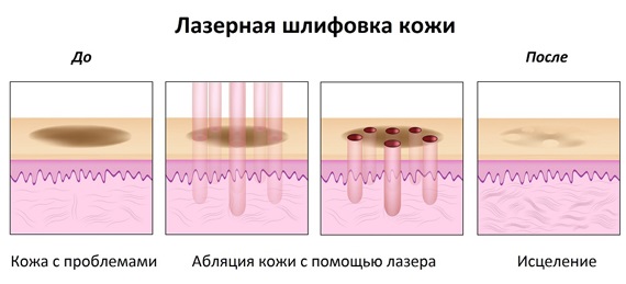 Pimples on the cheeks. The reasons for women, which organ is not in order, why it appears.Home treatment