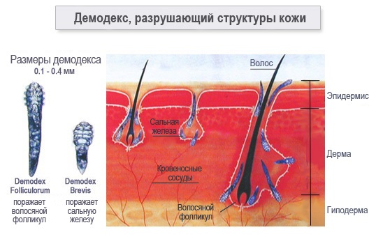 Pimples on the cheeks. The reasons for women, which organ is not in order, why it appears. Home treatment