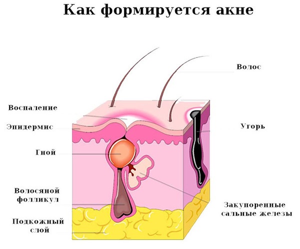 Acne on the neck in women. The reason why they appear and itch behind, on the chest, cheekbones, under the chin, during pregnancy. Treatment options