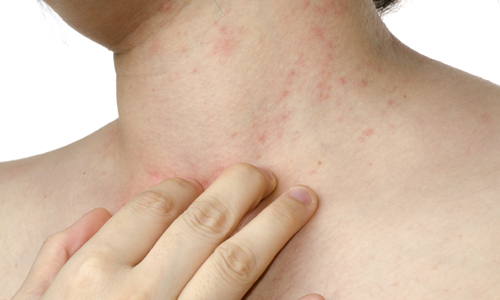 Acne on the neck in women. The reason why they appear and itch behind, on the chest, cheekbones, under the chin, during pregnancy. Treatment options