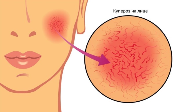 Acne on the neck in women. The reason why they appear and itch behind, on the chest, cheekbones, under the chin, during pregnancy. Treatment options