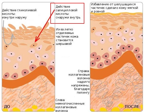 Salicylic acid for acne. Recipes, instructions for using talkers, ointments, alcohol solution