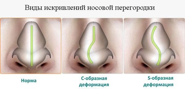 Septoplasty of the nasal septum.What is this laser, endoscopic, radio wave. Postoperative period, consequences