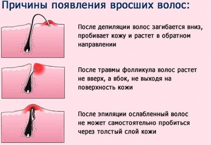 Shugaring Arabia. Reviews of cosmetologists about the paste. Depilation training