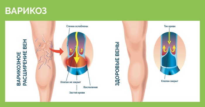 Sclerotherapy of veins in the legs - what is this procedure, the rehabilitation period, possible complications and consequences