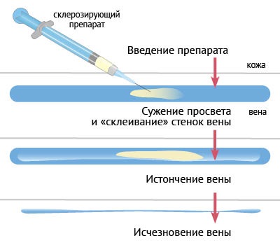 Sclerotherapy of veins in the legs - what is this procedure, the rehabilitation period, possible complications and consequences