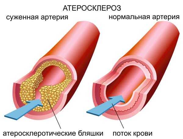 Scleroterapia delle vene delle gambe: cos'è questa procedura, il periodo di riabilitazione, possibili complicazioni e conseguenze