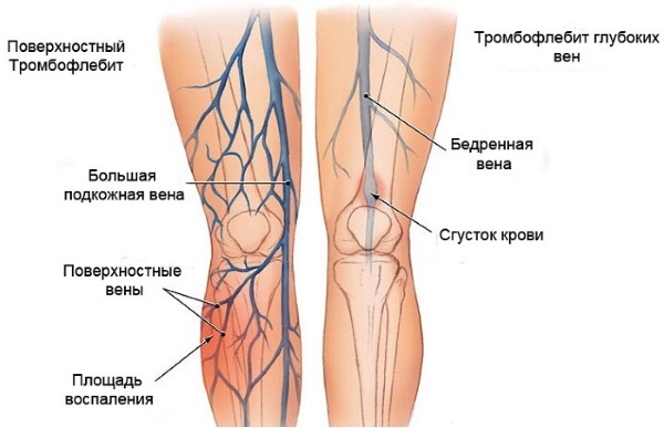 Scleroterapia delle vene delle gambe: cos'è questa procedura, il periodo di riabilitazione, possibili complicazioni e conseguenze