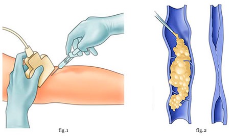 Scleroterapia delle vene delle gambe: cos'è questa procedura, il periodo di riabilitazione, possibili complicazioni e conseguenze